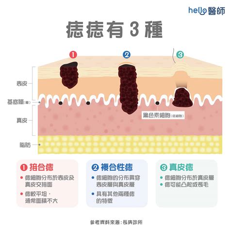 手臂長很多痣|為什麼臉上的痣越來越多？皮膚科醫師解析長痣原因、。